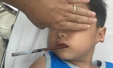 Hi hữu: Bệnh nhi 6 tuổi bị đũa xuyên thấu vùng hầu họng