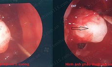 Đau âm ỉ vùng mũi mặt  người phụ nữ bị mắc u xương