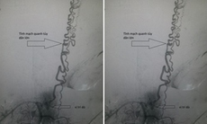 Điều trị cho bệnh nhân dị dạng mạch máu tủy sống hiếm gặp