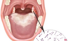 Đắk Lắk: Không để có thêm bệnh nhân tử vong do bệnh bạch hầu