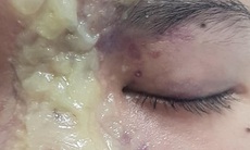 Nữ sinh 15 tuổi mù mắt sau khi tiêm filler nâng mũi