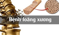 Những chất cần bổ sung để tránh nguy cơ loãng xương, gãy xương