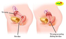 Sa tử cung độ 1 có nguy hiểm không? Cách khắc phục hiệu quả