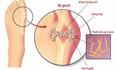 Thực đơn cho người bệnh gút