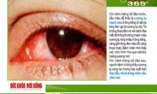 Nguyên nhân, dấu hiệu và cách phòng chống viêm mống mắt