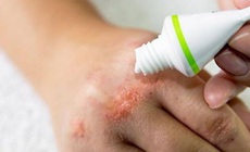 Liệu pháp mới trị viêm da dị ứng, thận trọng khi dùng thuốc