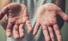 Sức khỏe bệnh nhân đầu tiên mắc đậu mùa khỉ tại Việt Nam diễn biến thế nào?