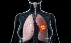 Biểu hiện sớm ung thư phổi&#160;ở giai đoạn đầu