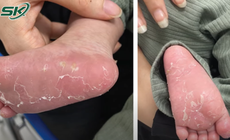 B&#233; trai 3 th&#225;ng mắc giang mai bẩm sinh