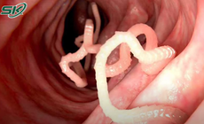 Kinh h&#227;i s&#225;n d&#226;y d&#224;i 1,5m k&#253; sinh trong ruột người phụ nữ 40 tuổi