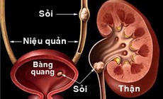 Việt Nam thuộc top mắc sỏi thận cao tr&#234;n thế giới: Chế độ ăn thế n&#224;o để hạn chế sỏi thận?