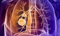Những triệu chứng bất thường cảnh b&#225;o ung thư phổi