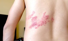 Bệnh zona dễ nhầm lẫn với bệnh n&#224;o?