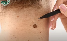 Ph&#225;t hiện ung thư da sau nhiều năm kh&#244;ng thăm kh&#225;m
