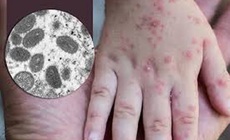 Xuất hiện lại ca đậu mùa khỉ, điều trị và phòng ngừa như thế nào?