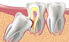 Răng mọc lạc chỗ c&#243; dấu hiệu g&#236;?