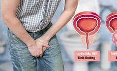 3 điều cần biết về bệnh ph&#236; đại tuyến tiền liệt