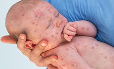Số ca mắc sởi tăng hơn 30 lần, WHO y&#234;u cầu h&#224;nh động khẩn cấp