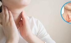 Bệnh l&#253; tuyến gi&#225;p c&#243; nguy hiểm kh&#244;ng?
