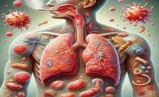 Vi&#234;m phổi: Biểu hiện, nguy&#234;n nh&#226;n, chẩn đo&#225;n v&#224; điều trị
