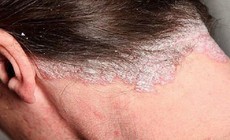 Ai dễ bị nhiễm nấm da đầu, biểu hiện nấm da đầu?