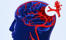Triệu chứng bệnh teo n&#227;o ở người gi&#224;