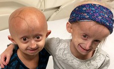 Trẻ nhỏ già đi như người già do bí ẩn gen lỗi trong hội chứng Progeria