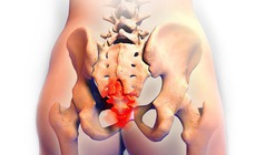 Phụ nữ chưa sinh con vẫn c&#243; thể bị rối loạn s&#224;n chậu