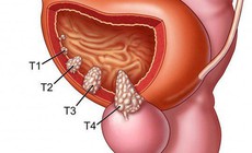 Thuốc phối hợp mới gi&#250;p giảm 40% nguy cơ tử vong do ung thư tuyến tiền liệt