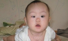 Trẻ mệt bất thường c&#243; thể mắc rối loạn nhược cơ bẩm sinh