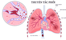 Thuy&#234;n tắc phổi ở người h&#250;t thuốc l&#225; v&#224; những người c&#243; nguy cơ mắc căn bệnh nguy hiểm n&#224;y