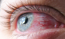 Bỏng&#160;mắt&#160;c&#243;&#160;biểu&#160;hiện&#160;như&#160;thế&#160;n&#224;o?