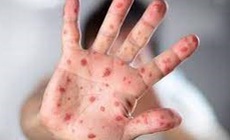 Cảnh gi&#225;c với nguy cơ bệnh sởi &#39;trở lại to&#224;n cầu&#39;