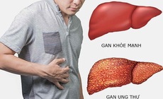 Đau bụng nhẹ, đi kh&#225;m ph&#225;t hiện ung thư gan