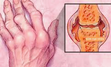 Vi&#234;m khớp dạng thấp ảnh hưởng đến cơ thể như thế n&#224;o?