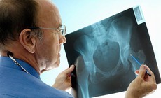 4 loại thực phẩm &#226;m thầm l&#224;m tăng nguy cơ lo&#227;ng xương