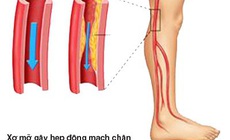 Bệnh động mạch chi dưới ở người cao tuổi dễ nặng l&#234;n v&#224;o m&#249;a lạnh