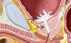 Kh&#244;ng thấy tinh dịch sau quan hệ cảnh b&#225;o xuất tinh ngược