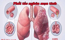 Nhận biết bệnh&#160;phổi&#160;tắc&#160;nghẽn&#160;mạn&#160;t&#237;nh