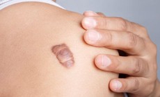 Chữa sẹo lồi c&#243; kh&#243; kh&#244;ng?