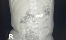 B&#233; trai nuốt 4 vi&#234;n đinh nam ch&#226;m đầu nhọn nguy hiểm
