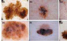 Dấu hiệu ung thư tế b&#224;o hắc tố ở da