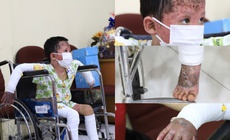 Bệnh nhi bỏng 65% vụ ph&#243;ng hỏa ở Gia Lai hồi phục ngoạn mục sau 38 ng&#224;y điều trị