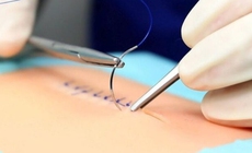 Đột ph&#225; phẫu thuật an to&#224;n nhờ n&#250;t thắt &#39;lập tr&#236;nh sẵn&#39;