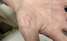 Biểu hiện mắc giun s&#225;n cần đi kh&#225;m sớm, kh&#225;m ở đ&#226;u?