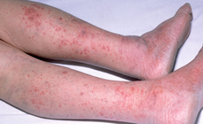 Vi&#234;m n&#227;o m&#244; cầu: Căn bệnh nguy hiểm c&#243; thể g&#226;y tử vong trong 24 giờ xuất hiện tại H&#224; Nội