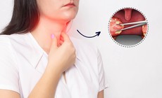 Lợi &#237;ch v&#224; rủi ro khi cắt amidan