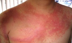 Biến&#160;chứng&#160;nguy hiểm của&#160;lupus ban&#160;đỏ&#160;hệ&#160;thống