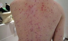 Nguy cơ biến chứng thủy đậu từ việc dùng thuốc sai cách