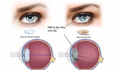 Dấu hiệu điển h&#236;nh nhận biết đục thủy tinh thể